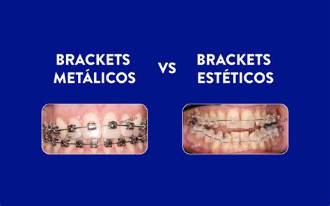 diferencia entre brackets y frenillos metalicos|Brackets transparentes versus brackets metálicos: .